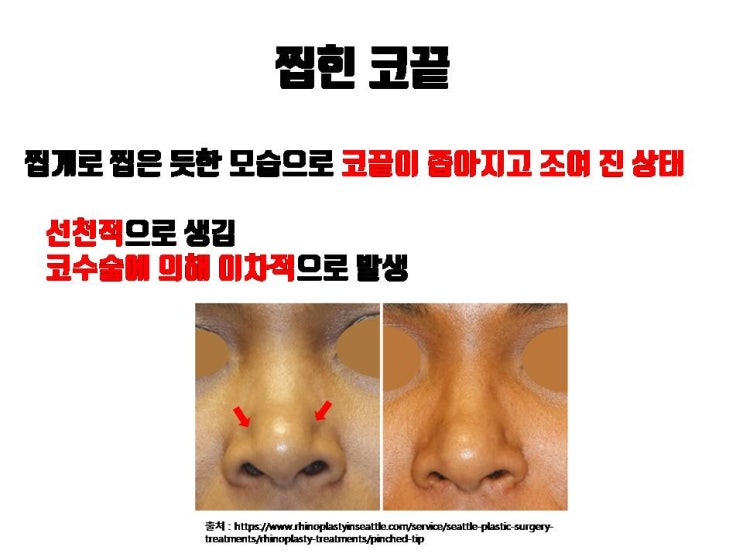  코끝 성형 후 발생한 찝힌 코, 교정됩니다 !!!