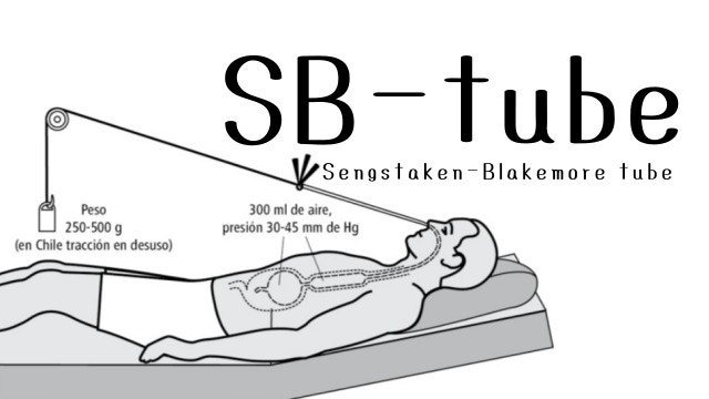 SB-tube (Sengstaken-Blakemore tube) : 네이버 블로그