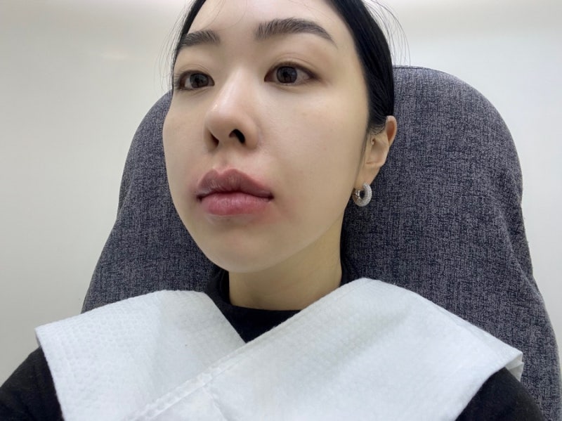 청담 피부과, 자연스러운 입술 필러