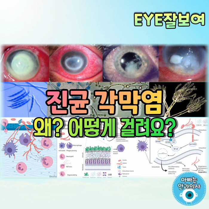  [EYE잘보여] 진균 각막염(Fungal Keratitis) (1) - 역학, 위험인자, 발병기전