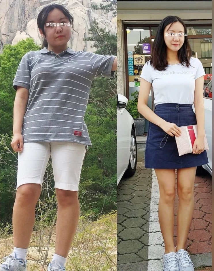 강남 안면비대칭 교정은 오직얼굴연구소 신사점에서 수술 없이 해결하자 강남 안면비대칭 교정은 오직얼굴연구소 신사점에서 수술 없이 해결하자