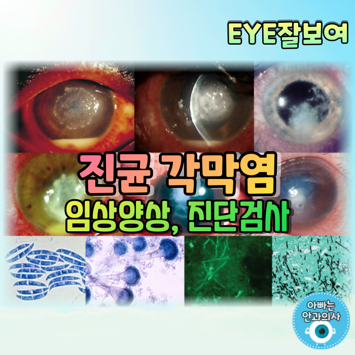 [EYE잘보여] 진균 각막염(Fungal Keratitis) (2) - 임상양상, 증상, 진단검사, 염색검사, 배양검사