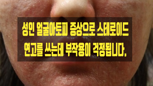  성인 얼굴아토피 증상으로 스테로이드 연고를 쓰는데 부작용이 걱정됩니다