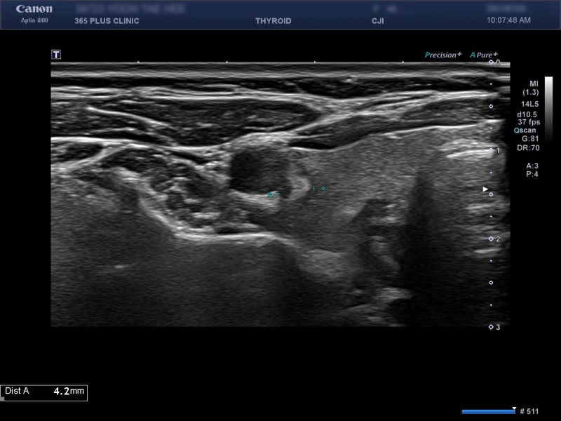 [하남갑상선] 갑상선암에 대하여 (체중감소로 내원하여 갑상선초음파 시행 -> papillary thyroid carcinoma 진단 사례)