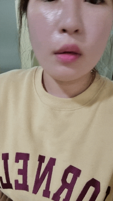  [내돈내산 솔직후기]이중턱관리/턱밑살/아큐주사/고용량 지방분해주사/윤곽주사시술/턱보톡스/턱살집중관리/솔직리뷰-노보정