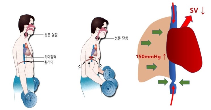  헬스 호흡법, 중량들 때 호흡법, 발살바 Valsalva maneuver, 뇌빈혈, 뇌출혈, 기흉의 발생