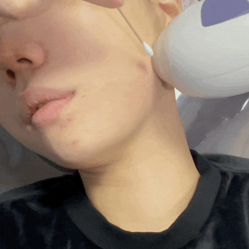  강남역 근처 신논현역 피부과 튠페이스 쳐진 볼살 ( 인디언 주름 ) 복구하는 법!