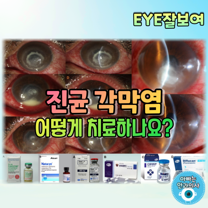  [EYE잘보여] 진균 각막염(Fungal Keratitis) (3) - 치료: 약물치료, 항진균제, 스테로이드