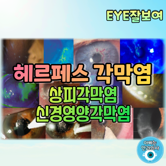  [EYE잘보여] 헤르페스각막염(단순포진각막염) (2) - 재발성 HSV 눈감염: 눈꺼풀염, 결막염, 감염상피각막염, 신경영양각막병증