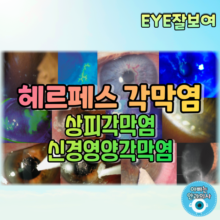 [EYE잘보여] 헤르페스각막염(단순포진각막염) (2) - 재발성 HSV 눈감염: 눈꺼풀염, 결막염, 감염상피각막염, 신경영양각막병증