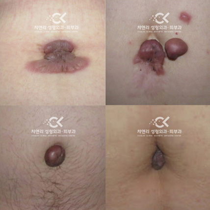  흉터성형 배꼽켈로이드치료는 30년 경력 & 전문성 갖춘 차앤리성형외과에서