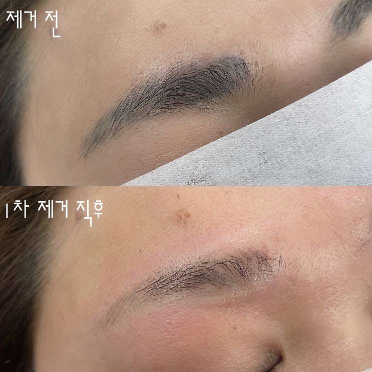 천안 눈썹문신제거와 커버업 예쁘게 잘하는 곳 천안 눈썹문신제거와 커버업 예쁘게 잘하는 곳