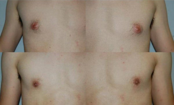 남자유륜축소수술 흉터없이 크기만 줄이기 : 네이버 블로그 남자유륜축소수술 흉터없이 크기만 줄이기 : 네이버 블로그