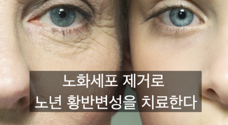  노화세포(좀비세포) 제거로 노년 황반변성을 치료할 수 있다?