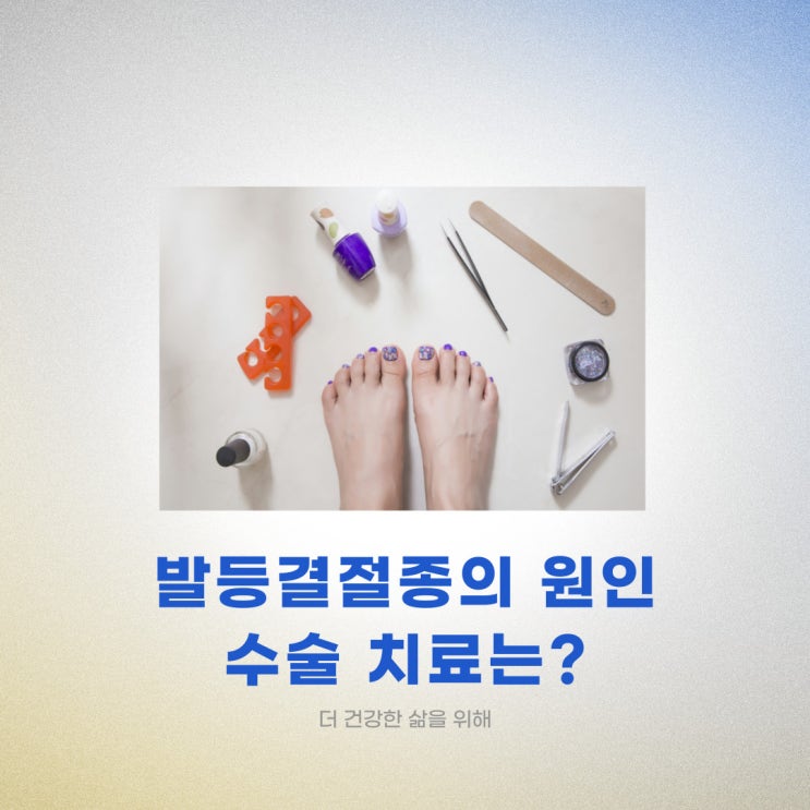  발등 물혹 발등 결절종의 원인과 수술 치료는?