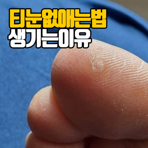  발바닥 티눈 제거, 발가락에 많이 생기는 이유