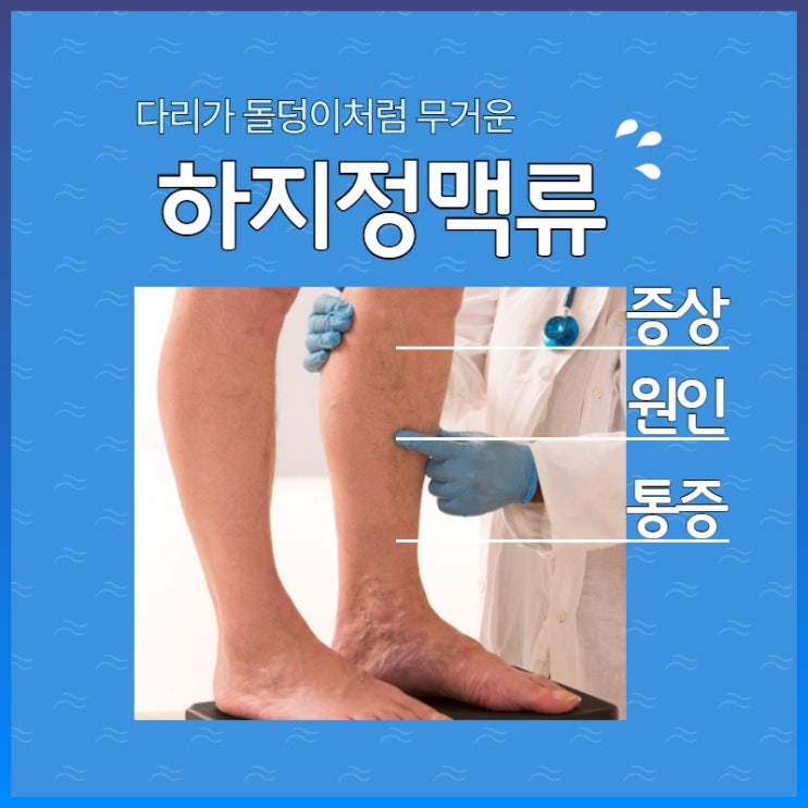 하지정맥류초기증상 원인과 통증 예방 방법까지