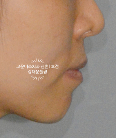  [돌출교정] 얼굴이 길고 돌출을 동반한 증례