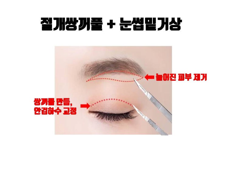  눈썹밑 거상술, 절개 쌍꺼풀 수술 함께 시행 받아 자연스럽고 젊어 보이는 눈 만들어 보세요!!!