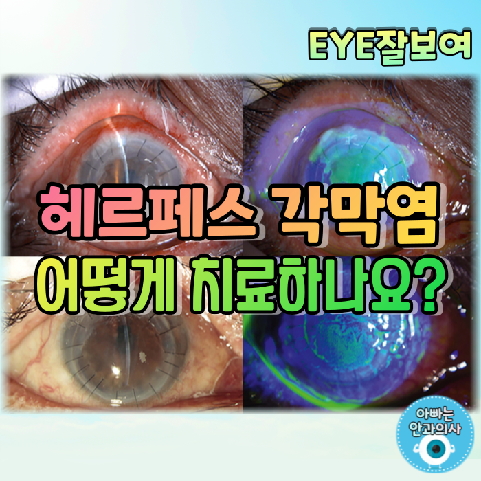 [EYE잘보여] 헤르페스각막염(단순포진각막염) (4) - HSV 눈감염: 치료방법 총정리