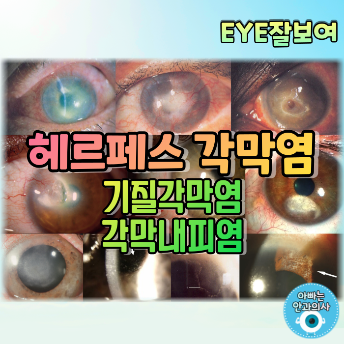 [EYE잘보여] 헤르페스각막염(단순포진각막염) (3) - 재발성 HSV 눈감염: 기질각막염, 각막내피염, 홍채섬모체염, 진단, 검사