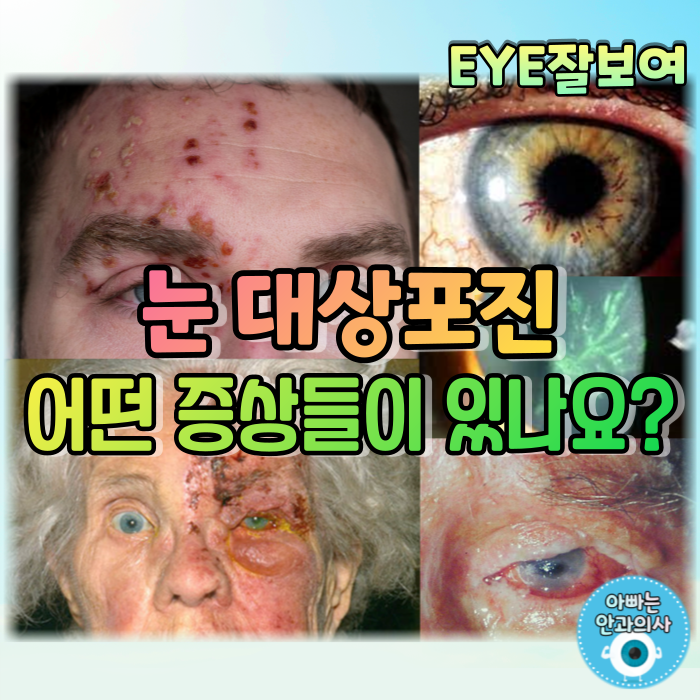 [EYE잘보여] 눈대상포진(Herpes Zoster Ophthalmicus) - 얼마나 흔할까?, 어떻게 걸리죠?, 어떤 증상들이 있나요?