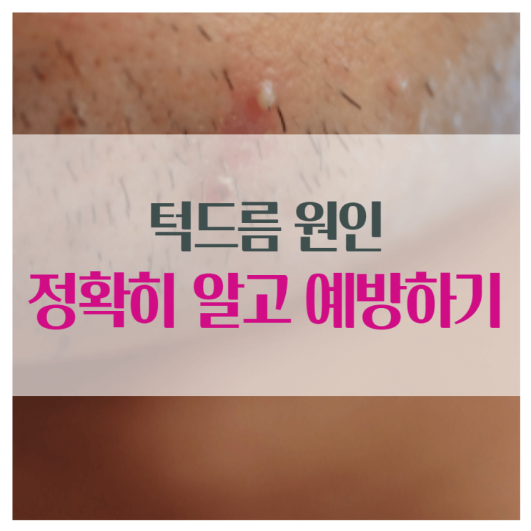  턱드름 원인 정확하게 알고 예방하기