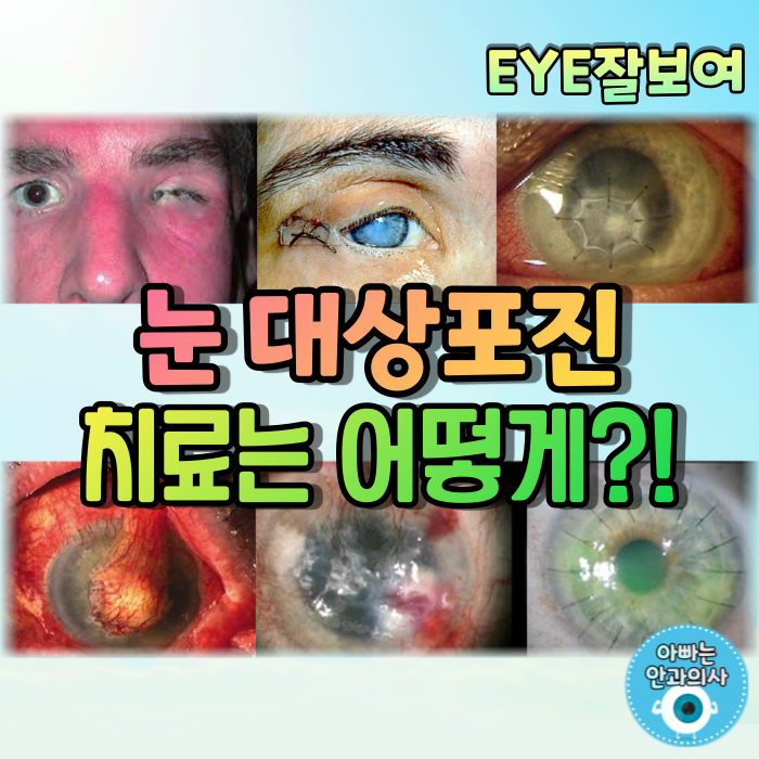 [EYE잘보여] 눈대상포진(Herpes Zoster Ophthalmicus) - 치료약물, 수술, 치료방법