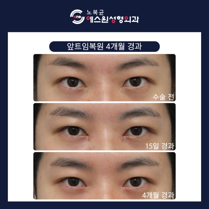 안각재건술을 고려하고 계시다면 압구정성형외과 5