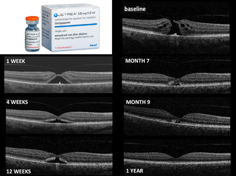 [EYE잘보여] 황반원공(Macular Hole) (2) - 감별질환(부분층 황반원공, 거짓황반원공), 약물치료, 수술(수술과정 ...
