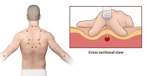  부산 어깨 목 담걸린 근막동통증후군 TPI(trigger point injection)