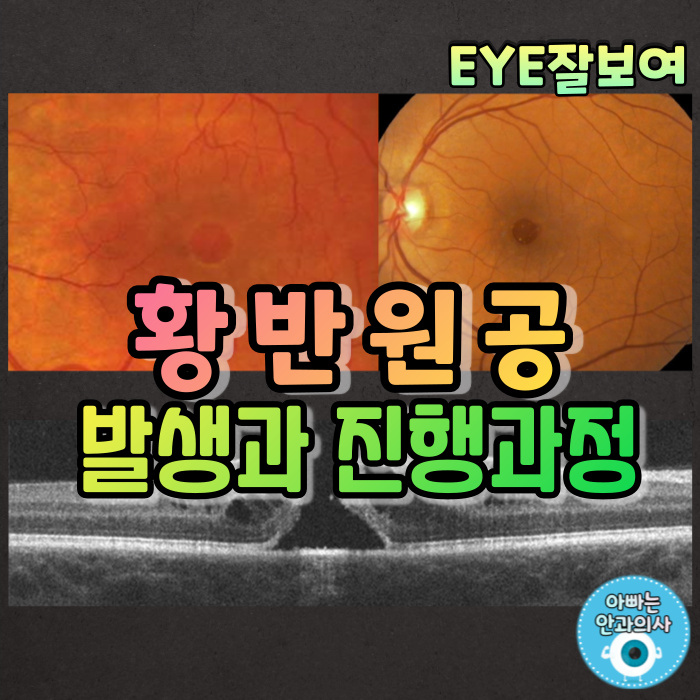  [EYE잘보여] 황반원공(Macular Hole) (1) - 어떻게 생기나요?, 제가 몇 기인가요?: 진행경과