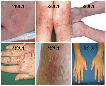 [아토피성 피부염]아토피성 피부염의 원인, 증상, 진단과 치료