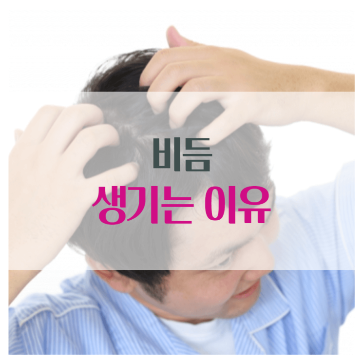  비듬 생기는 이유 확실히 알고 고치기