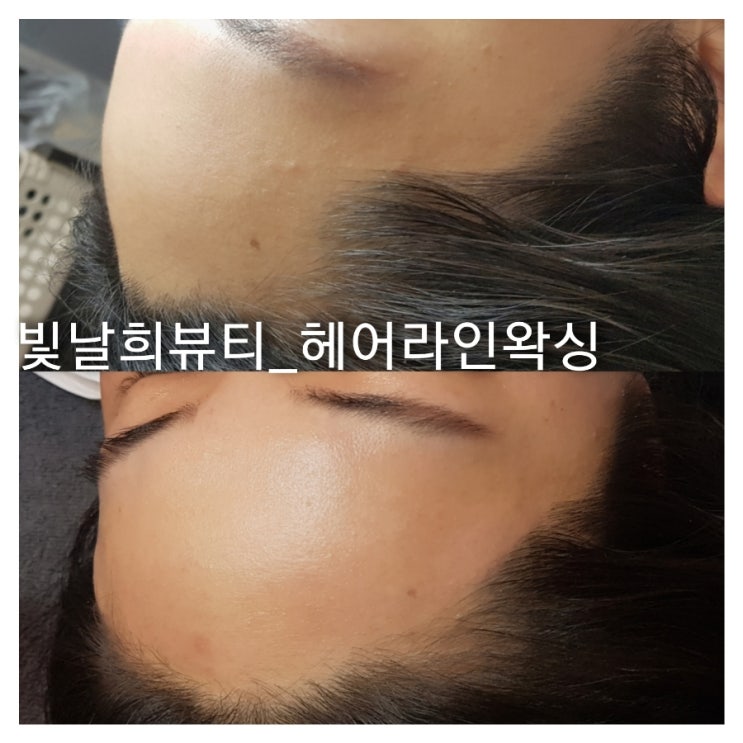  헤어라인왁싱으로 각진이마를 둥글게 만들기!