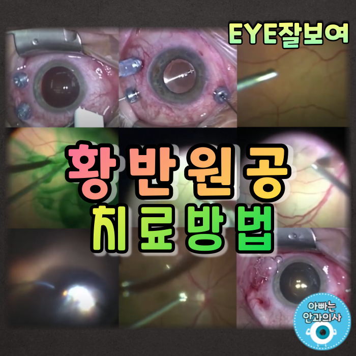  [EYE잘보여] 황반원공(Macular Hole) (2) - 감별질환(부분층 황반원공, 거짓황반원공), 약물치료, 수술(수술과정, 합병증, 수술예후)