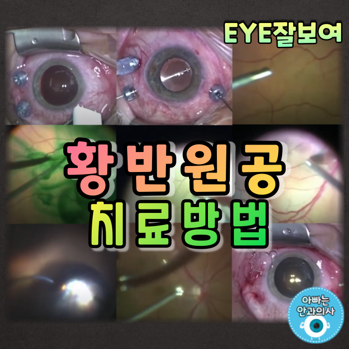 [EYE잘보여] 황반원공(Macular Hole) (2) - 감별질환(부분층 황반원공, 거짓황반원공), 약물치료, 수술(수술과정, 합병증, 수술예후)