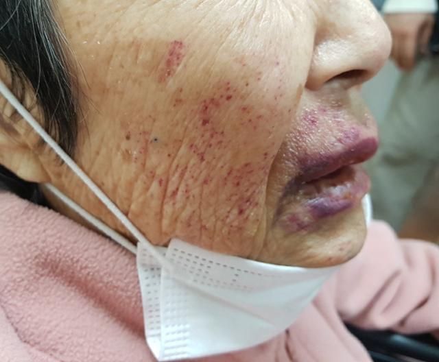 요양보호사가 할머니 이불로 덮고 마구 폭행, 쇄골·갈비뼈 골절 요양보호사가 할머니 이불로 덮고 마구 폭행, 쇄골·갈비뼈 골절