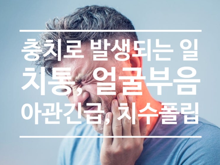 충치가 심한 경우 나타날 수 있는 증상, 얼굴 부음, 통증, 아관긴급(입이 안 벌어지는 증상), 치수 증식(pulp polyp)