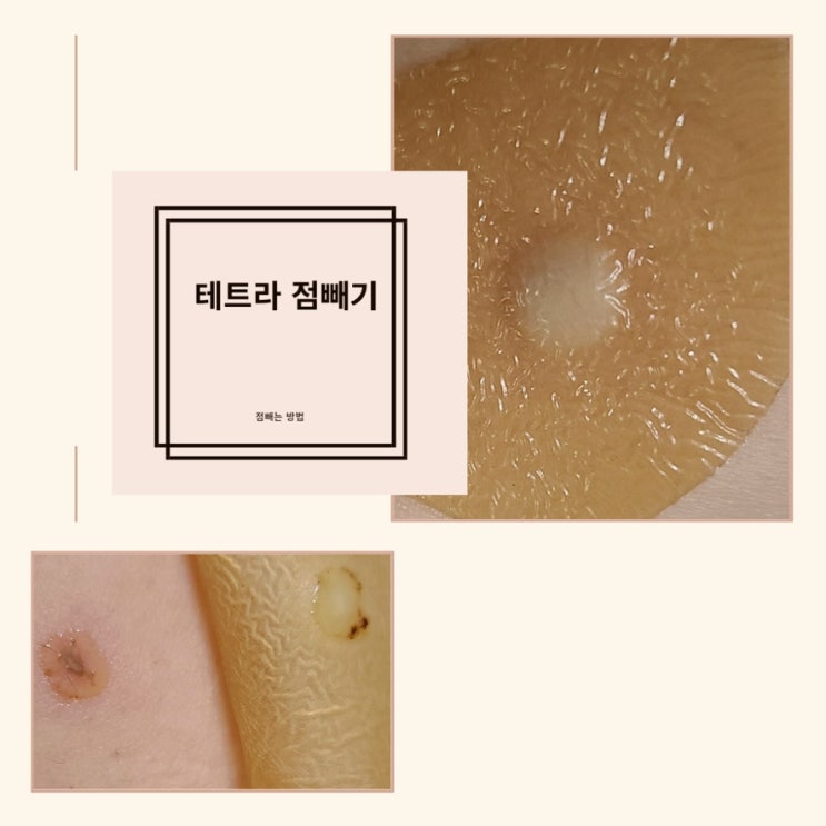 얼굴에점빼기 테트라 점빼기 후기 얼굴에점빼기 테트라 점빼기 후기