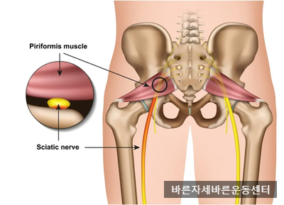 [서래마을PT]엉덩이통증,이상근증후군(Piriformis syndrome)
