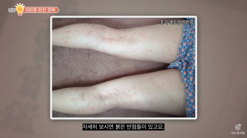 자반증 – 헤노흐쇤라인자반,