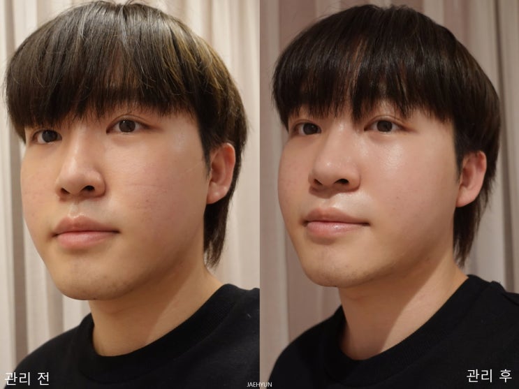  위뷰티 안면비대칭 경락마사지 옆광대작아지는법 2회차 후기