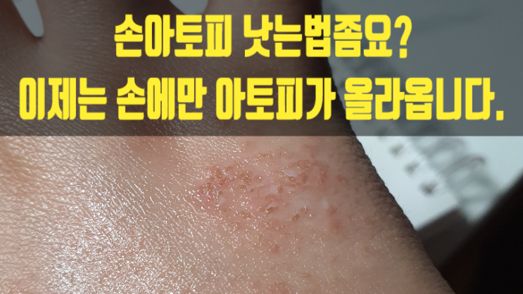  손아토피 낫는법좀요? 이제는 손에만 아토피가 올라옵니다.