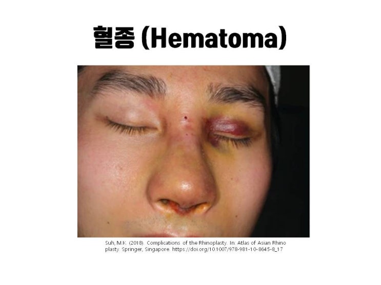  코성형 후 응급 상황!!! 반드시 코재수술로 코조기 교정 받아야 하는 증상들!!!