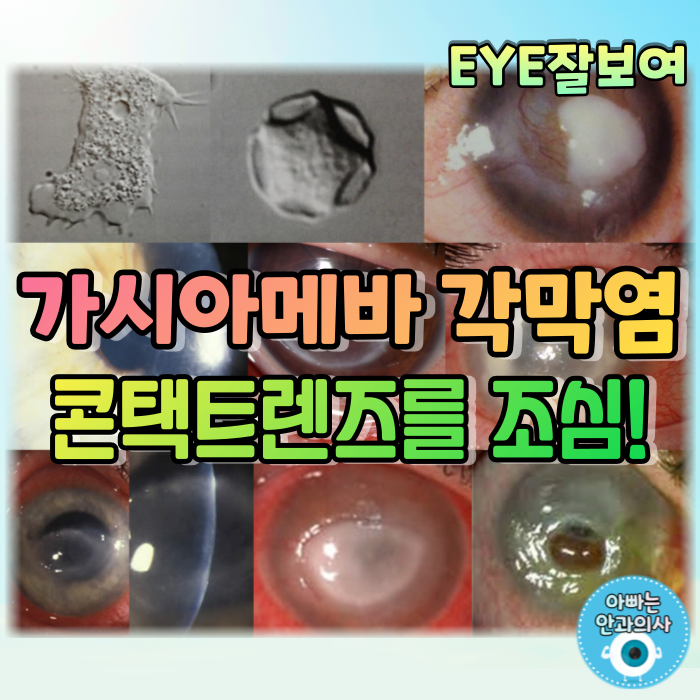 [EYE잘보여] 콘택트렌즈를 조심하세요! - 가시아메바 각막염 (1): 정의, 역학, 원인, 발병기전, 증상, 임상양상