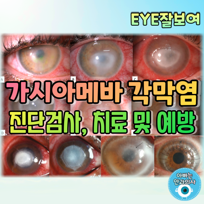 [EYE잘보여] 콘택트렌즈를 조심하세요! - 가시아메바 각막염 (2): 진단, 검사, 치료(약물, 수술), 예방