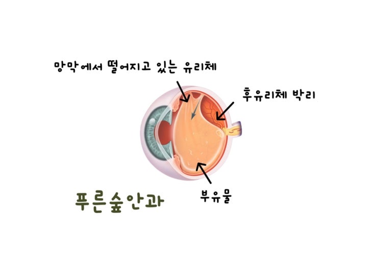  눈앞에 뭔가 떠다닌다면 꼭 확인해야 하는 4가지, 해운대 안과전문의가 알려드립니다.