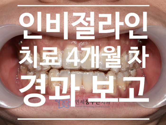 하남 인비절라인 치료 경과보고(치료 4개월 차) / 인비절라인 장점, 단점