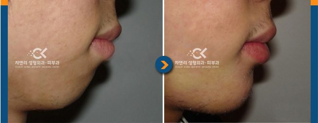  보형물 이용한 무턱수술로 입체감 있는 얼굴형 만들기